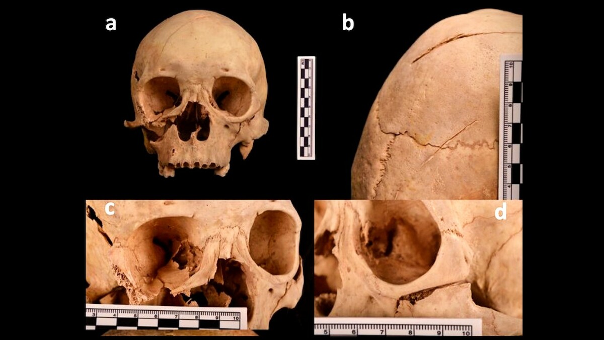 Urazy na czaszce mężczyzny z szybu grobowca z Shiyanzi, Chiny. Źródło: <a href='https://www.researchgate.net/publication/355356702_Hiding_a_leaf_in_the_forest_uncovering_a_1300-year-old_homicide_case_in_a_2000-year-old_cemetery' rel='noopener'>Archaeological and Anthropological Sciences</a>.