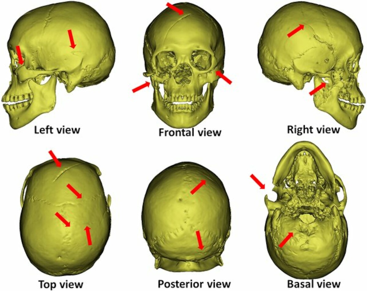 Urazy na czaszce mężczyzny przedstawione na rekonstrukcji 3D, Shiyanzi, Chiny. Źródło: <a href='https://www.researchgate.net/publication/355356702_Hiding_a_leaf_in_the_forest_uncovering_a_1300-year-old_homicide_case_in_a_2000-year-old_cemetery' rel='noopener'>Archaeological and Anthropological Sciences</a>.